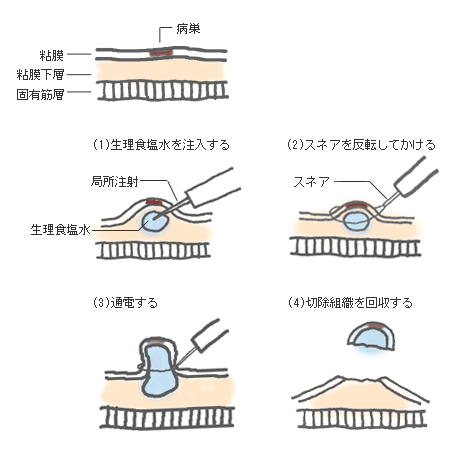 大腸 ポリープ 切除 後 お腹 が 張る