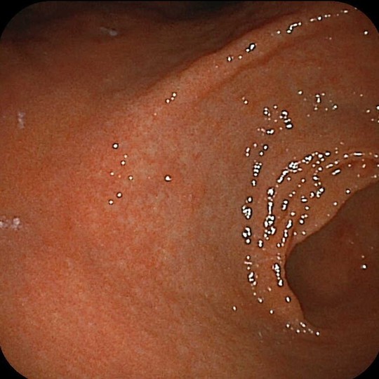 胃癌を見つけやすくする最新の内視鏡 - 大腸内視鏡/胃カメラ I