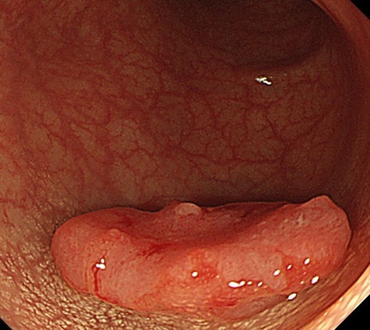 大腸がん検診:便潜血検査のススメ - 大腸内視鏡/胃カメラ I 桐山