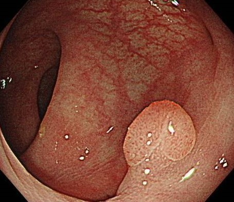 ポリープ 切除 大腸 明日は主人が大腸ポリープ切除の日です。