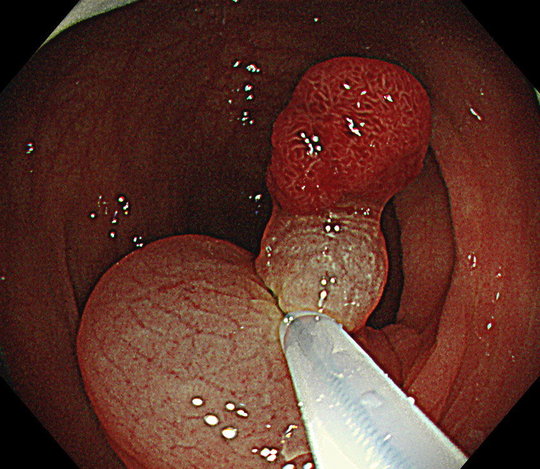大腸ポリープ切除の方法 大腸内視鏡 胃カメラ I 桐山クリニック 高崎 群馬 埼玉